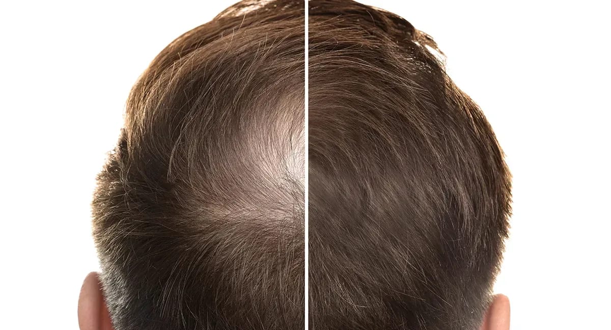 Before and after hair results